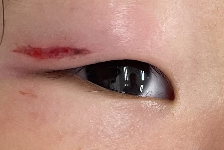 目周りの外科的治療